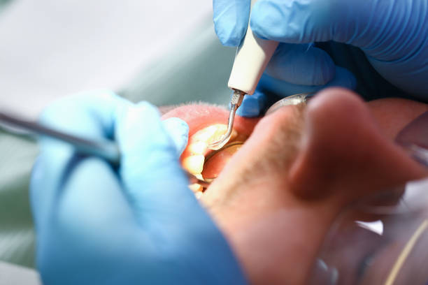 Best Emergency Root Canal Treatment in Morehead City, NC